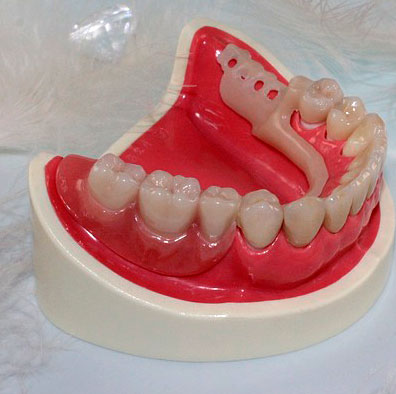 Tratamento - Prótese dentária em Arujá